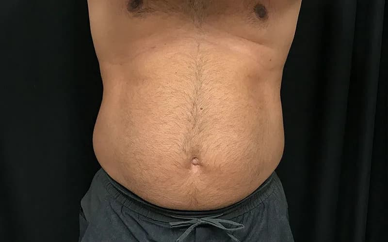 Body contouring, after