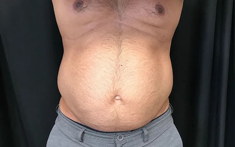 Body contouring, before