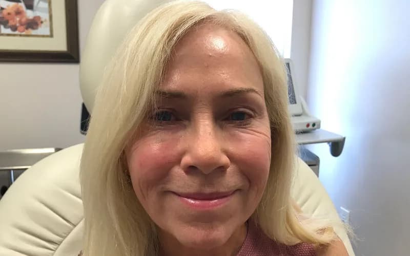 Facial rejuvenation, after