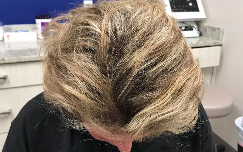Hair restoration, after