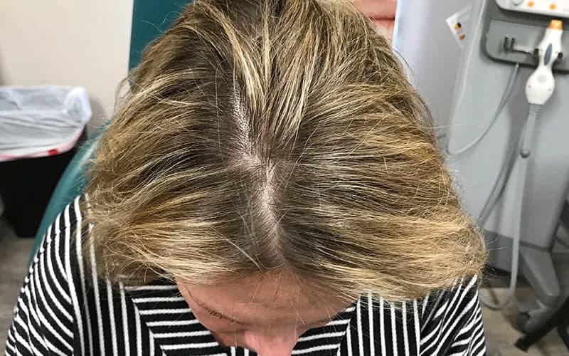 Hair restoration, before