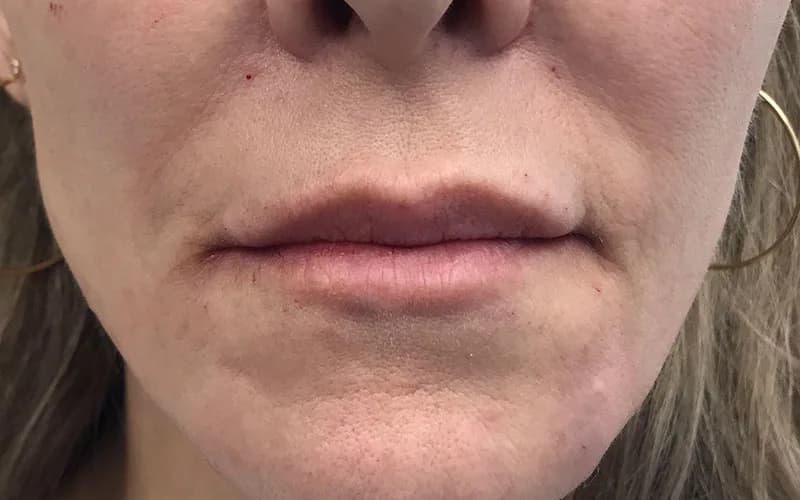 Lines around the mouth, after