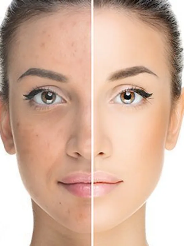 Acne treatment at The Dermatology, Laser & Vein Center in Cincinnati