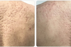 Acne Scar Correction