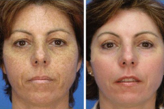 Melasma BBL Treatment