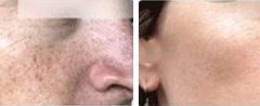 Melasma BBL Treatment