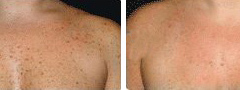 Melasma BBL Treatment