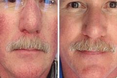 Melasma BBL Treatment