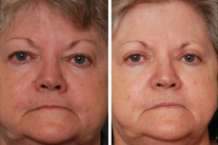 Melasma BBL Treatment