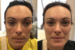 Melasma BBL Treatment