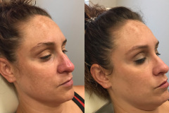 Melasma BBL Treatment