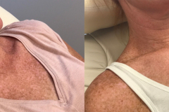 Melasma BBL Treatment