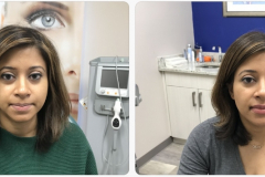 Botox for Masseter Hypertrophy