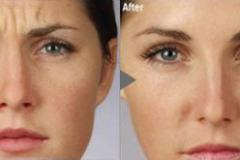 Botox