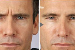 1_botox_2