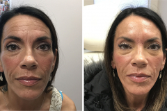 botox-before-after