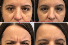 botox-filler-social