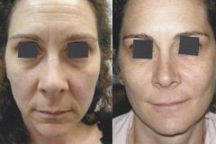 botox-front