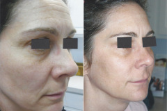 botox