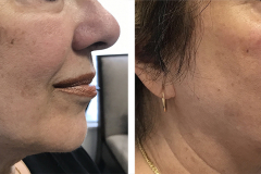 brown-spot-removal-before-after