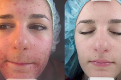 Chemical Peels