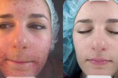 chemical-peel-1
