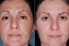 chemical-peel-3