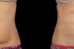 CoolSculpting Elite