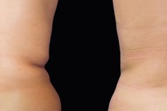 p1-CoolSculpting-back