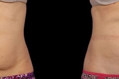 p1-CoolSculpting-front