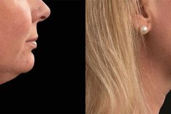 p2-CoolSculpting