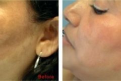 cosmelan-depigmentation