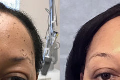 Dermatosis Papulosa Nigra (DPN)