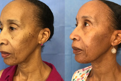 dpn-2