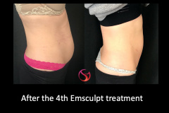 Emsculpt-before-after-2