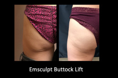 Emsculpt-side-by-side-2