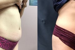 emsculpt-1-ba-2