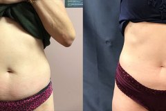 emsculpt-1-ba