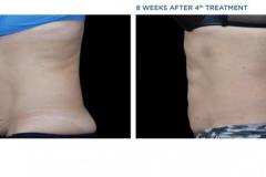 emsculpt-1