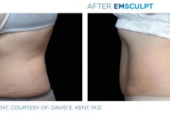 emsculpt-2