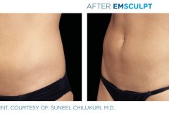 emsculpt-3