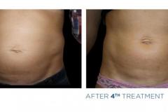 emsculpt-5