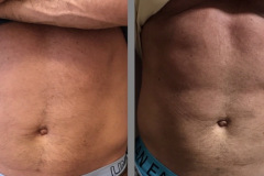 emsculpt-ba-1