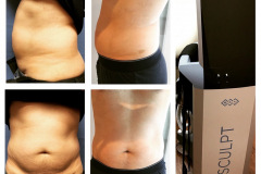 emsculpt-ba-2