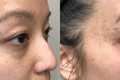 Facial Vessels