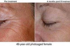 GentleWavesBeforeandAfter