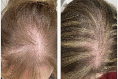 Hair Restoration