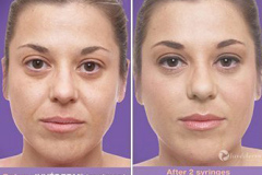 Juvederm