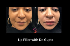 Lip-filler-AM