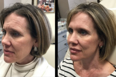 side-view-rejuvenation-2